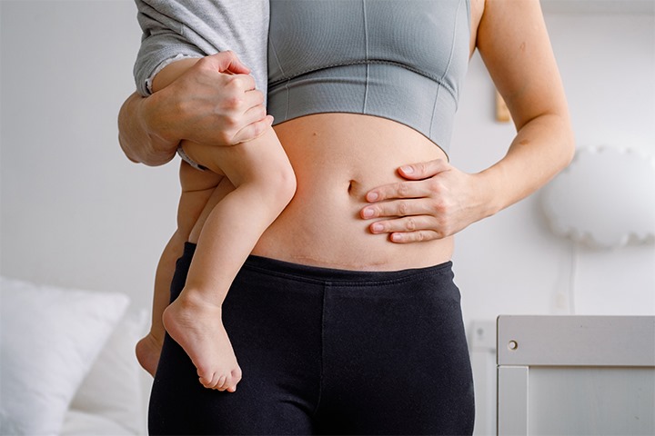 نصائح وتوجيهات للنساء بعد الولادة القيصرية للتعامل مع المضاعفات المحتملة