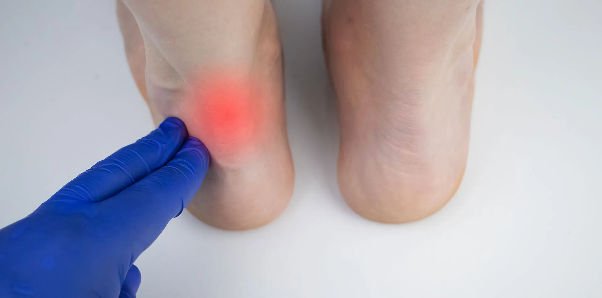 Achilles Tendinopathy: Causes, Symptoms & Treatment | The Feet People  Podiatry
