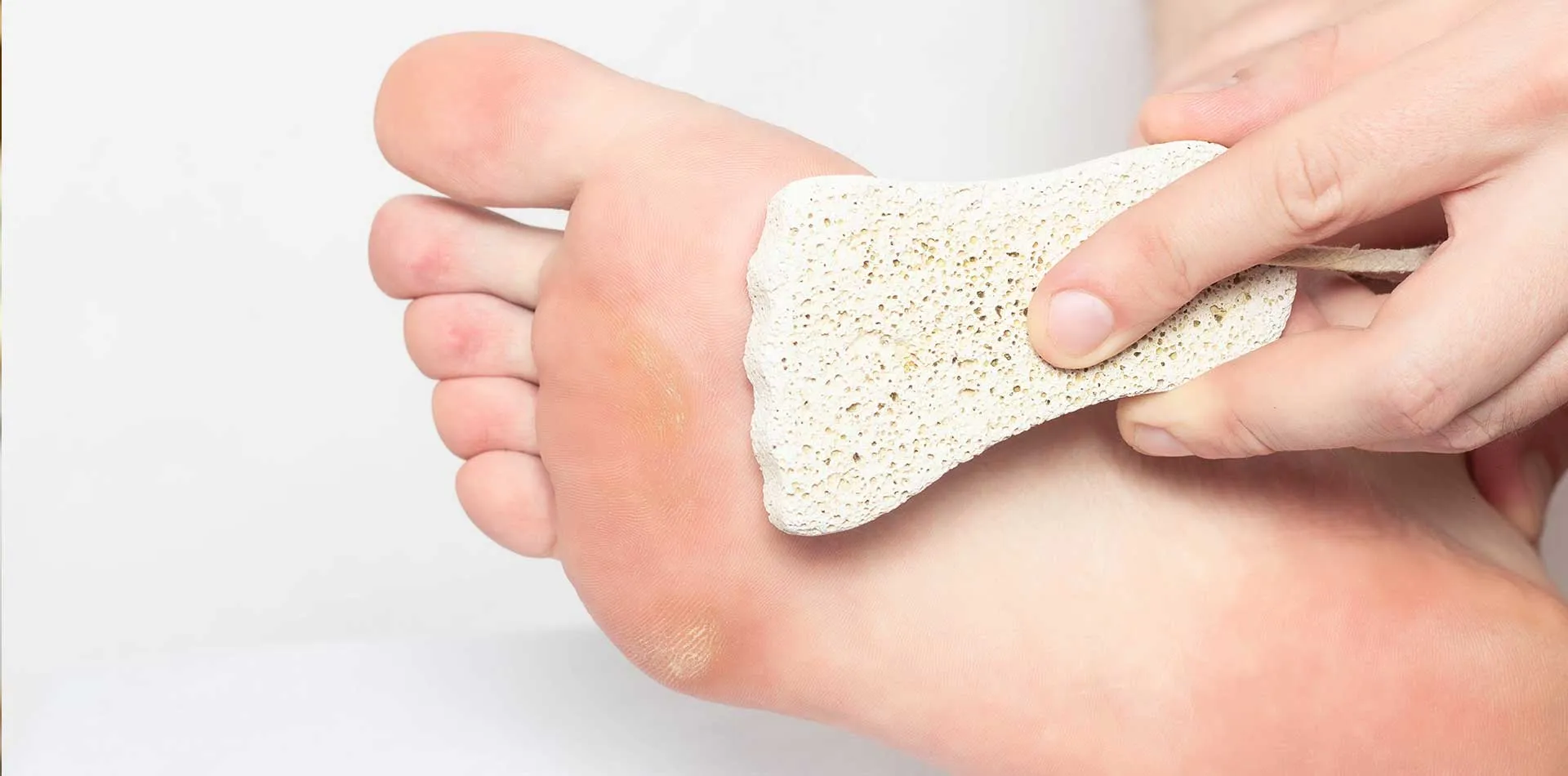 Foot Corns & Calluses Treatment / Removal in Singapore 2023 - Singapore  Sports And Orthopaedic Clinic