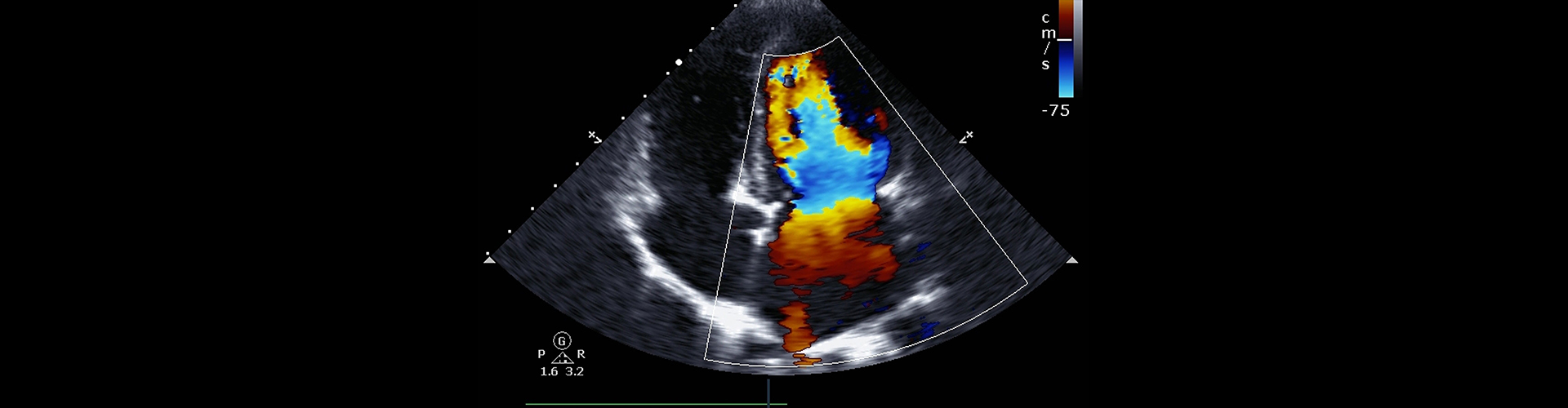 Valvular Heart Disease Treatment| American Hospital Dubai